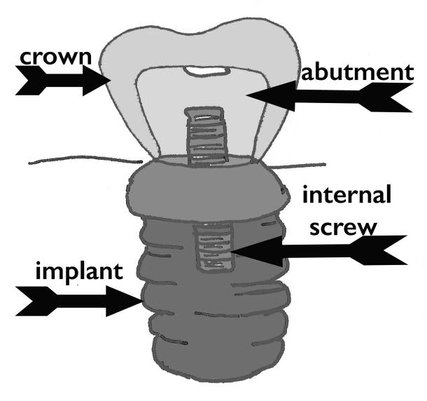 dental implant